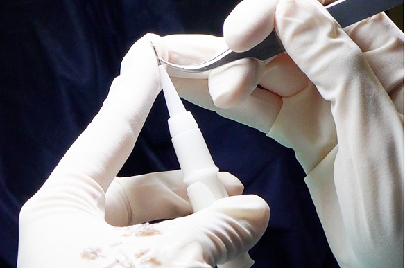 Como implantamos os seus folículos num transplante capilar?