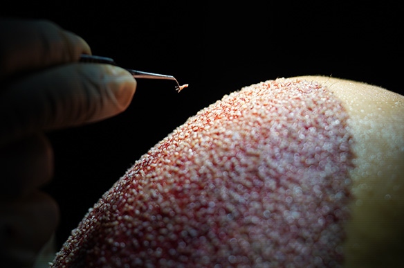 De que forma são realizados os nossos transplantes capilares?